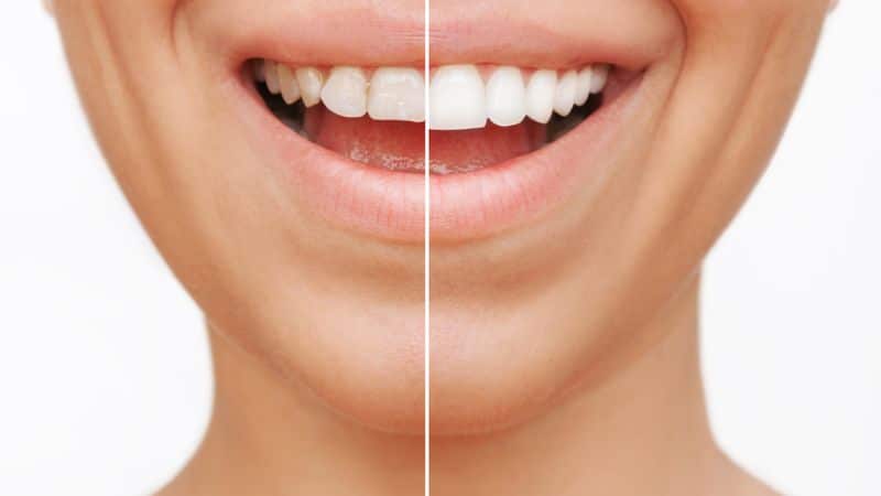Esthétique du sourire